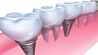 Los implantes dentales All On 4 valen la pena por dos razones