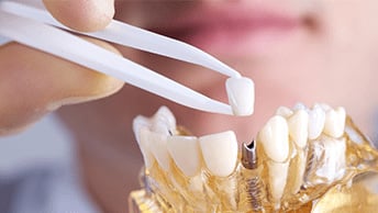 Las dentaduras postizas cuestan desde $ 300 hasta $ 4,000