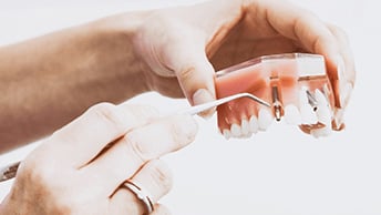 Aquí está el costo promedio de los implantes dentales