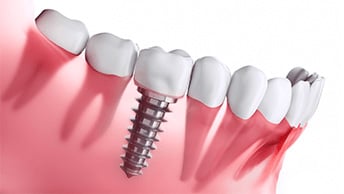 Los precios promedio para un solo diente e implantes de boca completa