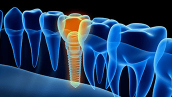 What Are The Differences Between Dentures And Dental Implants?